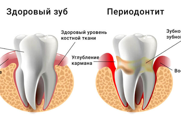 Лечение периодонтита